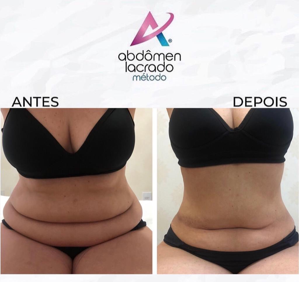 abdomen lacrado