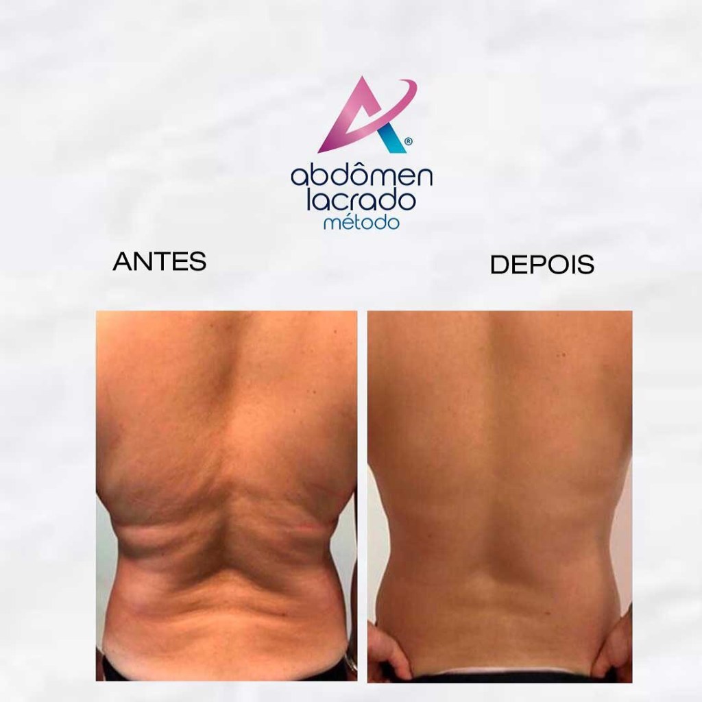 abdomen lacrado