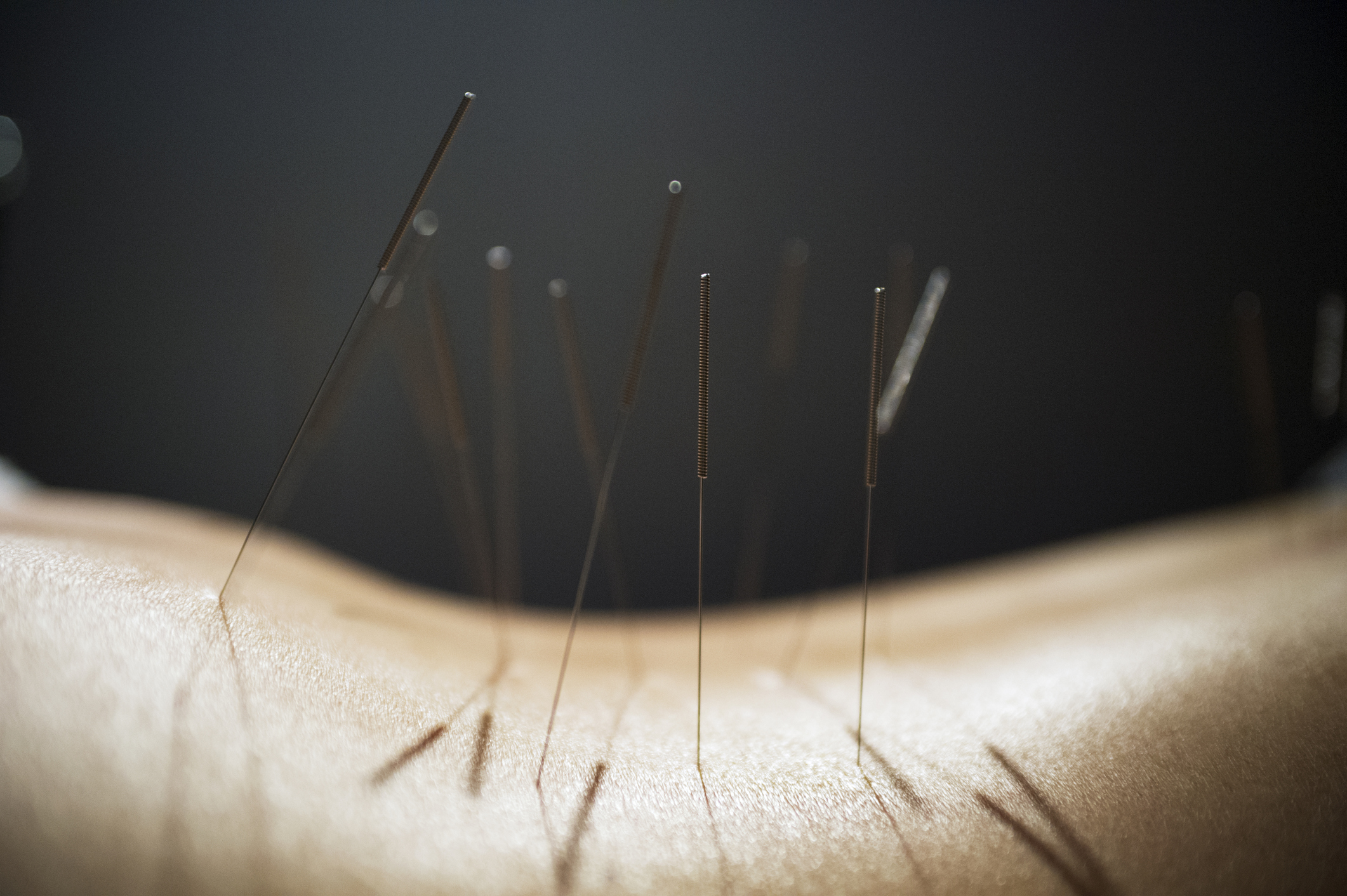 Acupuncture одежда. Акупунктура. Акупунктура коллагеновыми нитями. Акупунктура языка. Акупунктура шелком.