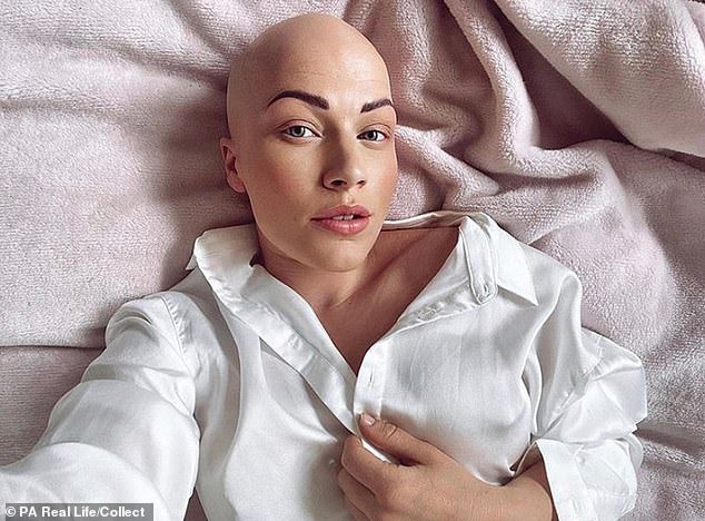 Dançarina com alopecia abandona peruca e inspira outras mulheres