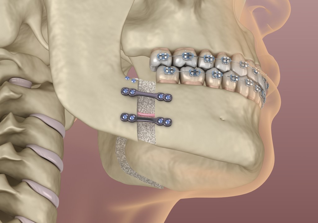 Mandibular Advancement surgery. Medically accurate dental 3D illustration. ortognatica