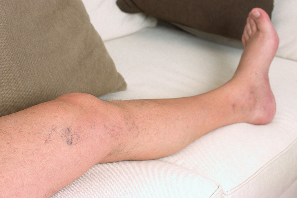 Varizes são hereditárias?