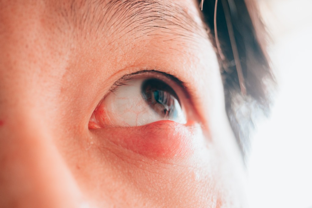 man with hordeolum ill eye homem com terçol externo