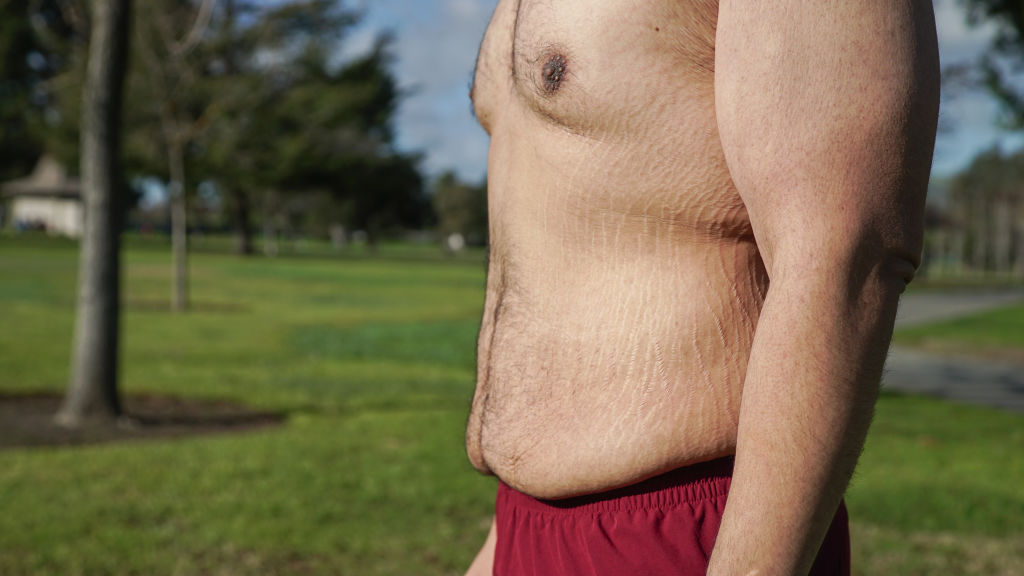 Fios de PDO para tratar a flacidez corporal?