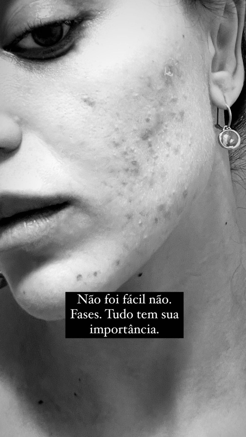 Rafa Kalimann mostrando rosto com acne