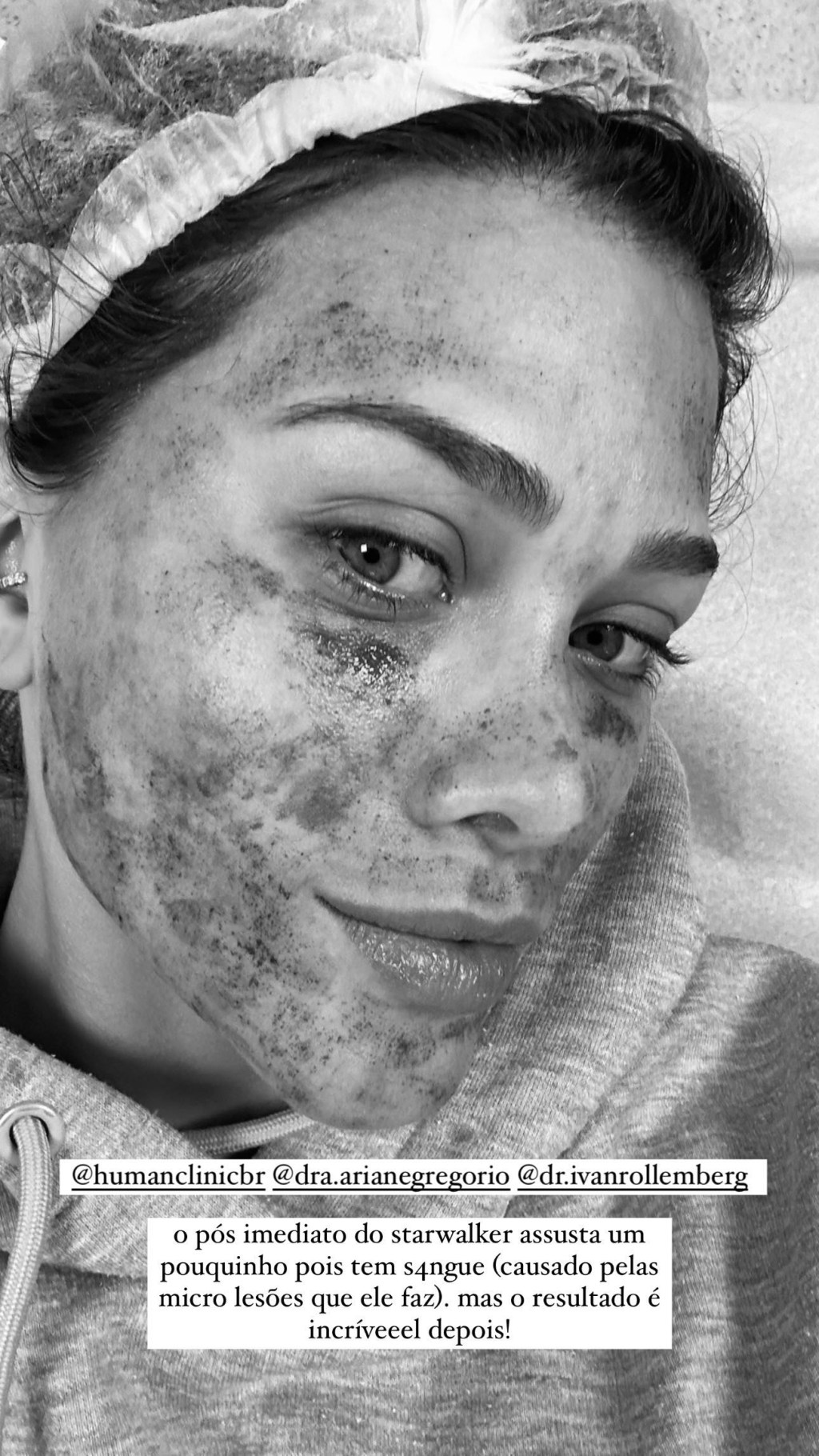 Flavia Pavanelli com o rosto machucado após realização de laser