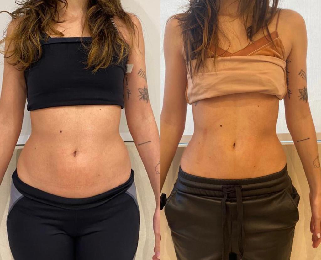 Injeções redutoras de gordura: tudo o que você precisa saber