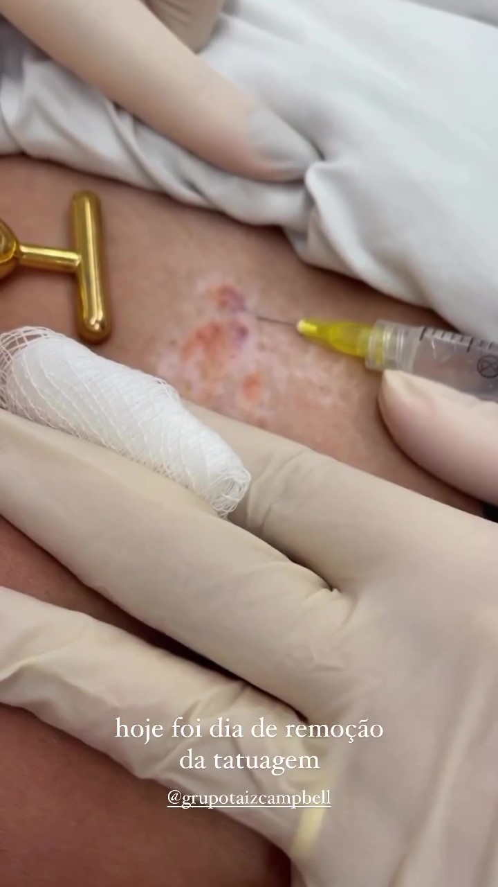 Mari Gonzalez removendo tatuagem com laser