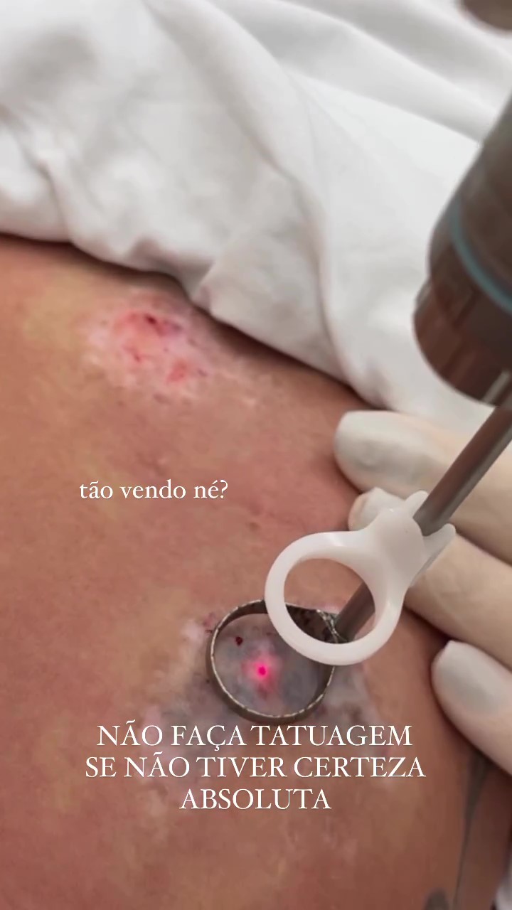 Mari Gonzalez removendo tatuagem com laser