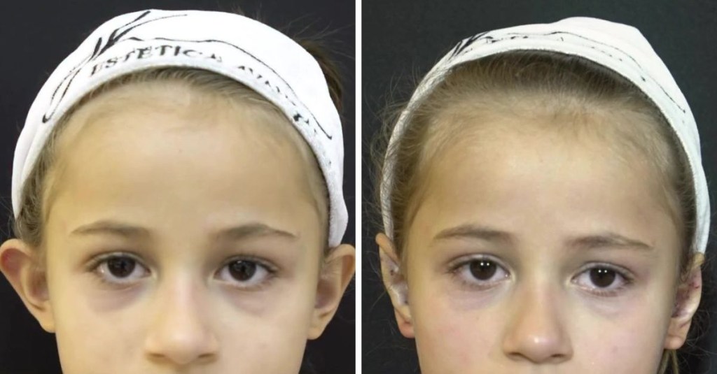 Antes e depois da otomodelação da filha da Deolane Bezerra