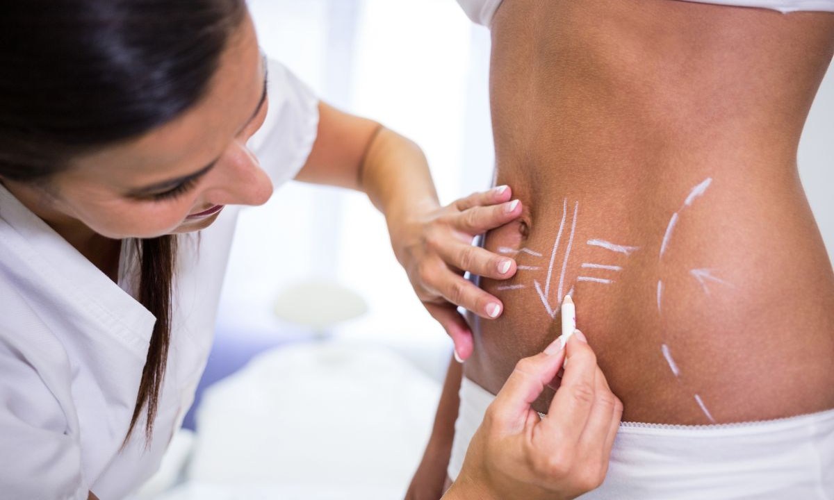 Os principais tipos de lipoaspiração