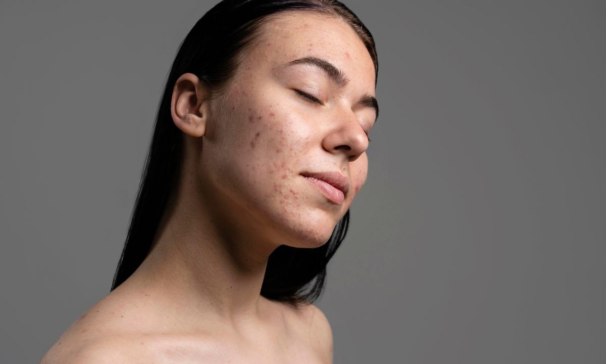 O que pode ser feito para tratar a acne?