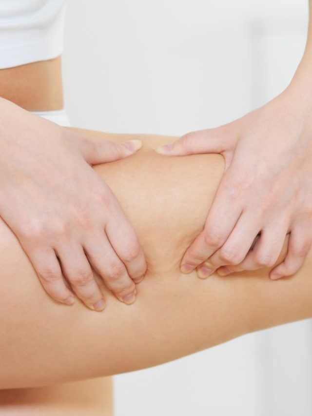 Capa de: Lipedema pode ser tratado com cirurgia plástica?