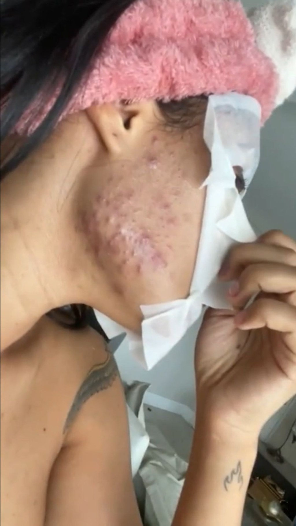 Flay mostrando o rosto com acne após o uso do chip da beleza
