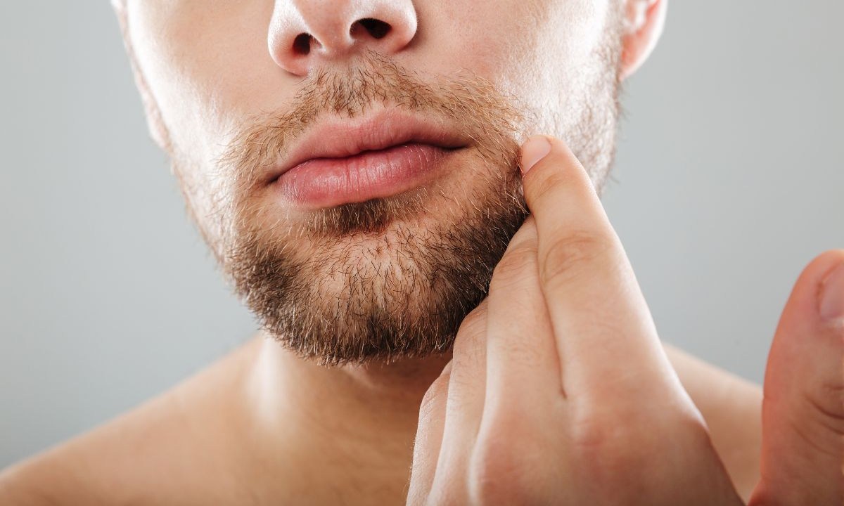 Espinhas na região da barba