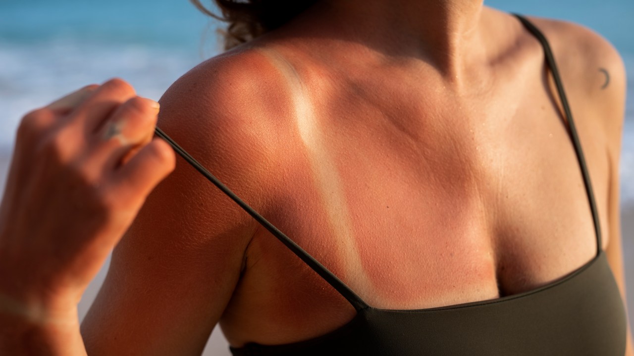 Veja quais são as orientações da dermatologista para cuidar da pele queimada por sol