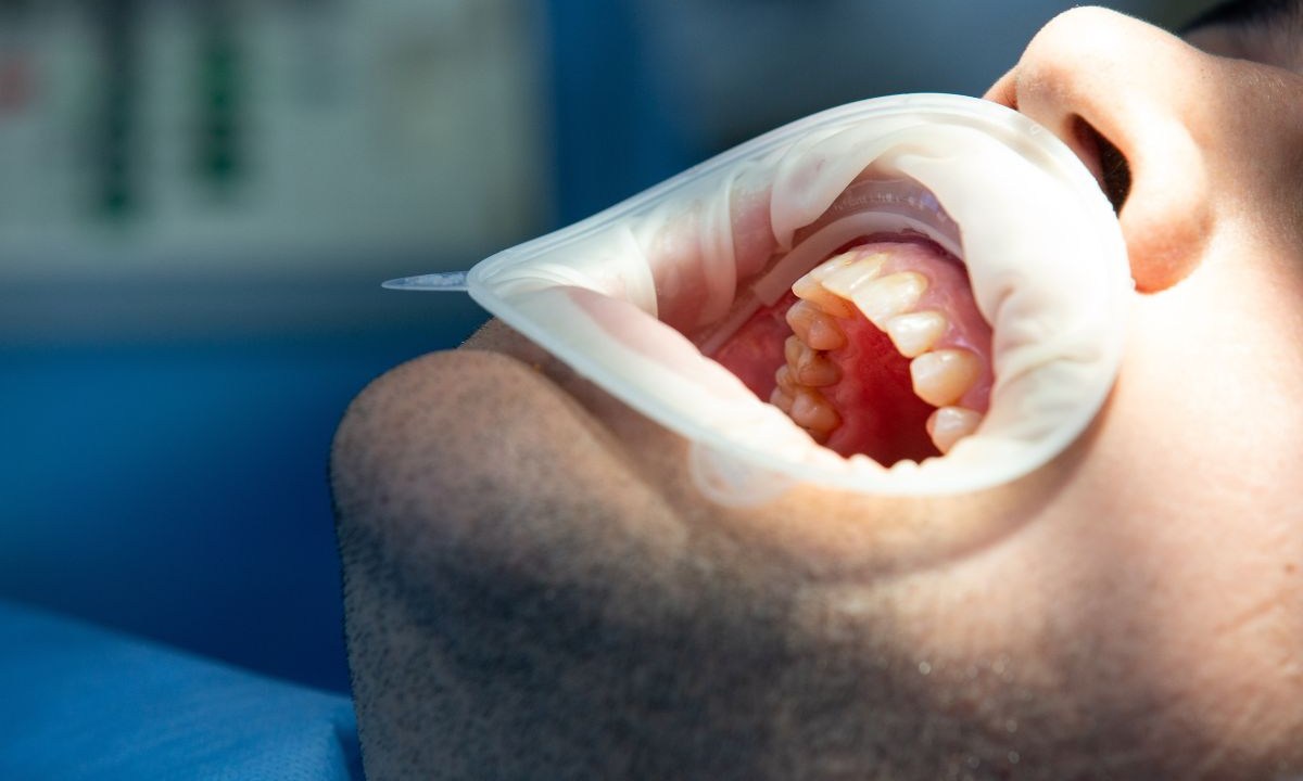 rejeição de implante dentário