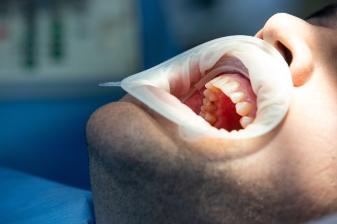 rejeição de implante dentário