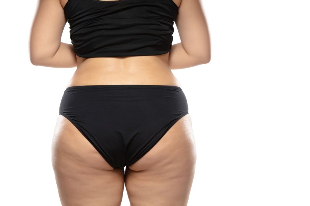 Como saber se tenho lipedema ou celulite? Entenda as diferenças