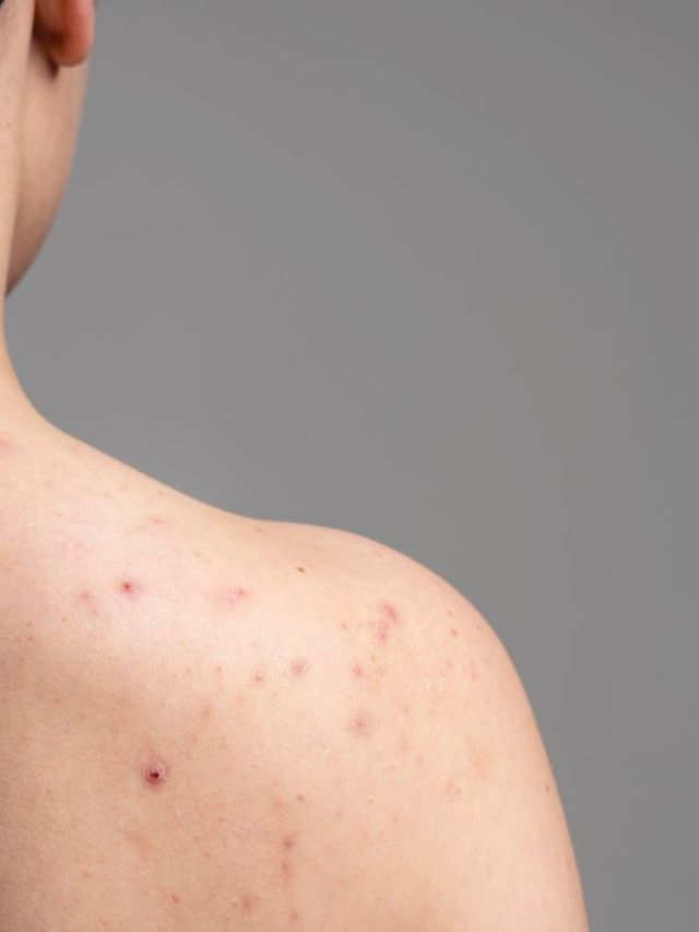 Capa de: Conheça as principais causas de espinhas nas costas