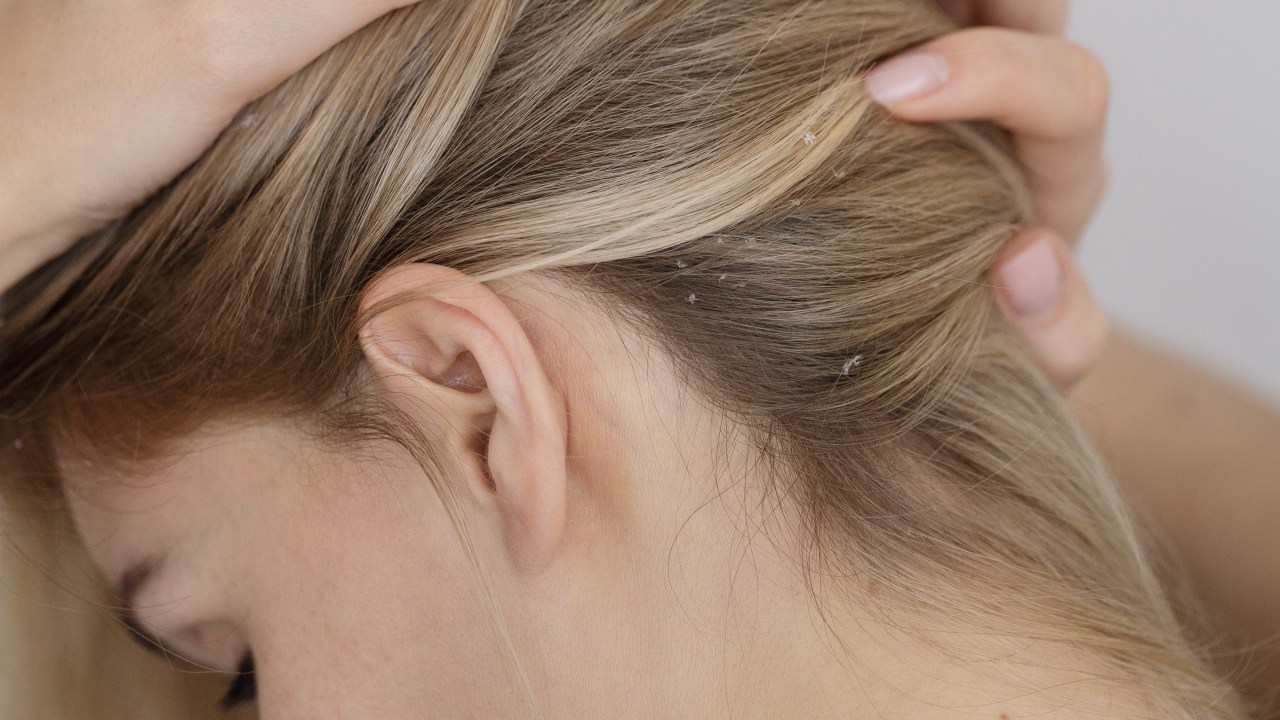 Profissional aponta os tipos de dermatite mais comuns e como evitar a caspa