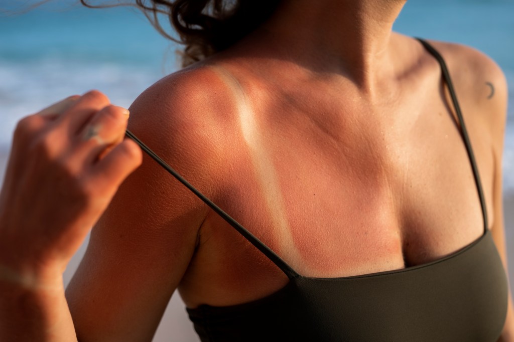 Como acalmar a pele queimada: 9 loções pós-sol eficazes