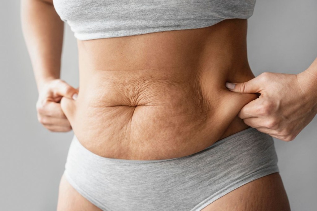 5 dicas eficazes para combater a flacidez após emagrecimento