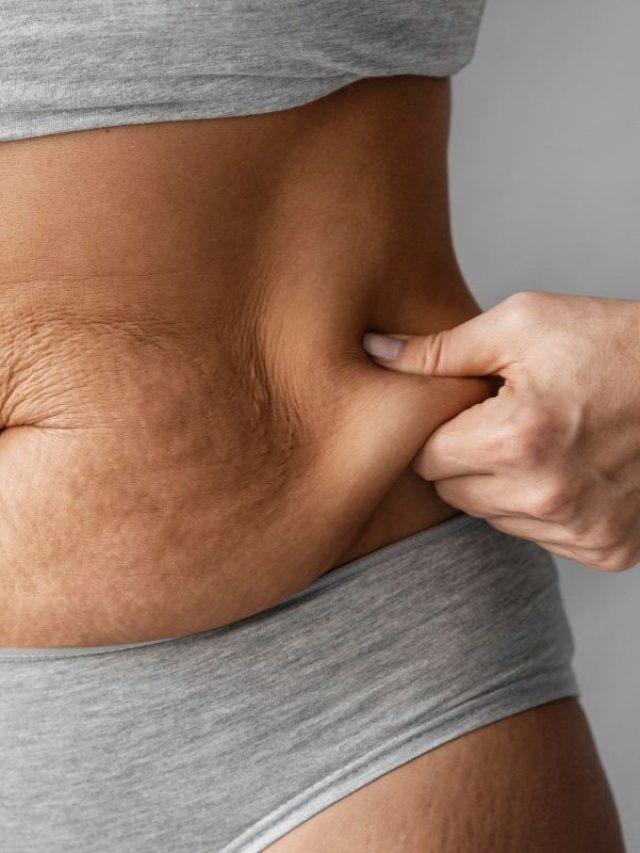 Capa de: 5 dicas para combater a flacidez após emagrecimento